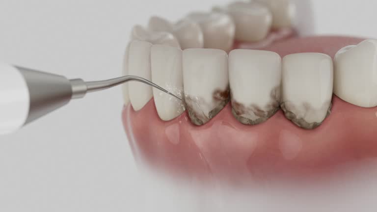 Reliable Tooth Extraction contractor in Stepping Stone, CO by Smile Center Dentistry